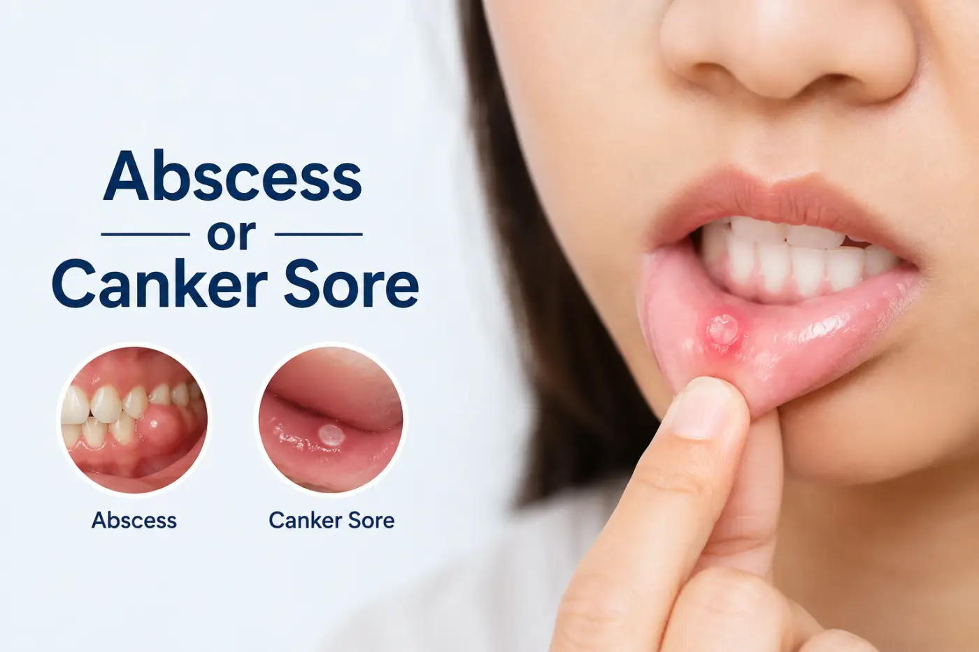 abscess-or-canker